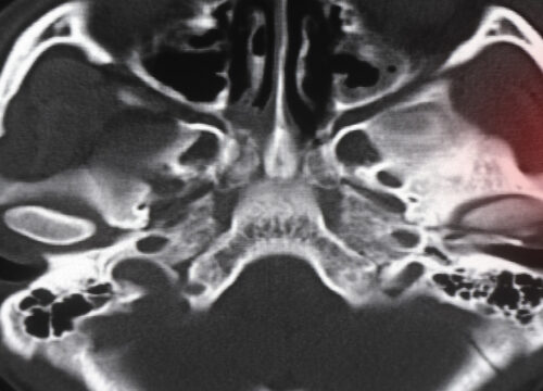 Photo of an x-ray showing an orbital fracture