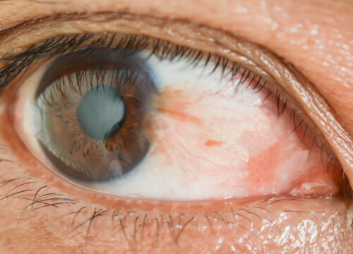 Photo of a pterygium on a person's eye