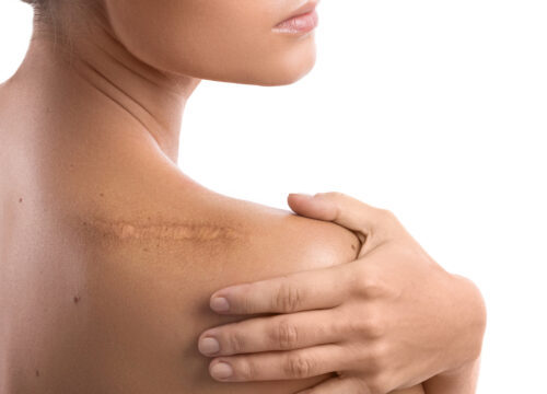Photo of a scar on a woman's shoulder
